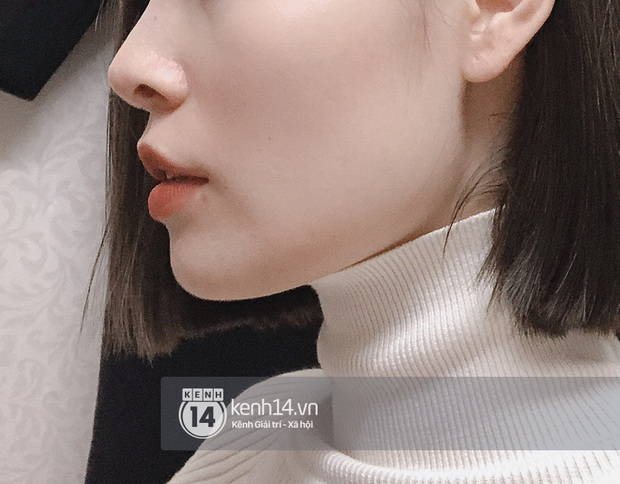 Tôi đi tiêm botox gọn hàm: 1 lần botox Mỹ, 1 lần botox Hàn, mặt chỉ thay đổi sương sương chứ không lột xác được như người ta - Ảnh 2.