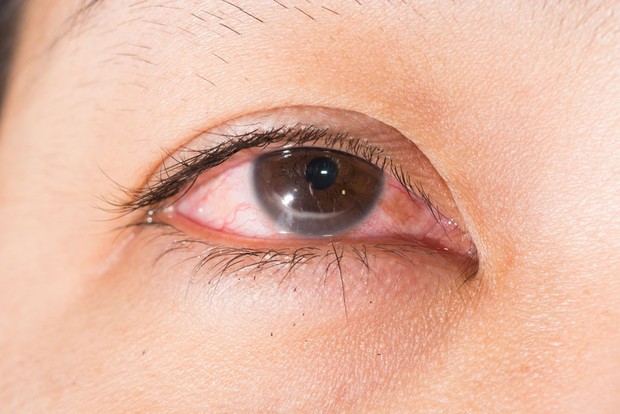 Nhiều người gặp phải tình trạng ngứa khóe mắt nhưng không biết rõ nguyên nhân đến từ đâu - Ảnh 2.