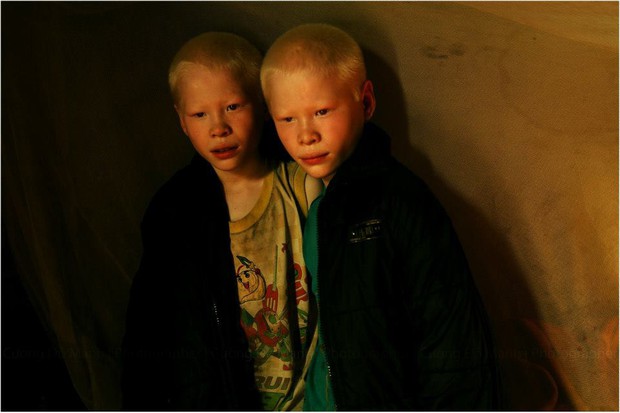 Hai anh em bạch tạng ở Hà Tĩnh từng gây cảm xúc trong bộ ảnh Twins vào 6 năm trước giờ ra sao? - Ảnh 6.