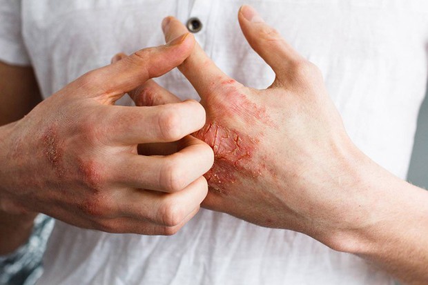 Quan hệ đường miệng - một trong những hành vi dễ lây lan bệnh tình dục và đây là loạt bệnh bạn cần biết - Ảnh 4.