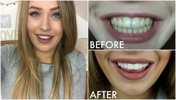 Tẩy trắng răng bằng máy ngậm trắng đang hot hiện nay có thực sự hiệu quả? - Ảnh 4.