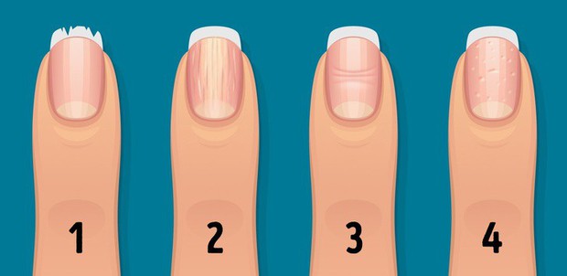 Nhận biết tình trạng sức khỏe của bạn thông qua các đặc điểm trên móng tay - Ảnh 2.