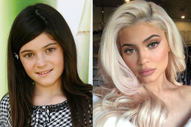 Kylie Jenner tiêm thẩm mỹ môi nhìn cực quyến rũ nhưng Hiệp hội bác sĩ thẩm mỹ Úc  lại cảnh báo có nguy cơ gây mù lòa - Ảnh 1.