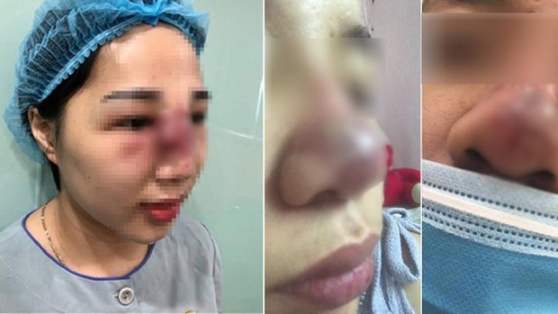 Vì sao thời nay nhiều người chọn phương pháp tiêm thẩm mỹ thay vì phẫu thuật thẩm mỹ? - Ảnh 6. Vì sao thời nay nhiều người chọn phương pháp tiêm thẩm mỹ thay vì phẫu thuật thẩm mỹ? - Ảnh 6.