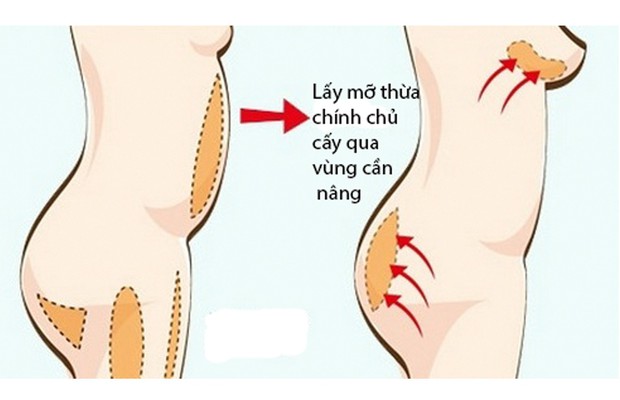 Có tới 3 kiểu tiêm thẩm mỹ đang thịnh hành nhất hiện nay nhưng không phải ai cũng nắm rõ ưu, nhược điểm từng kiểu - Ảnh 5.