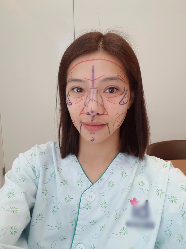 Lưu Đê Ly khoe trải qua 6 ca phẫu thuật ở Hàn để “đập mặt làm lại”, đẹp hay không chưa bàn chỉ biết là quá dũng cảm rồi! - Ảnh 2. Lưu Đê Ly khoe trải qua 6 ca phẫu thuật ở Hàn để “đập mặt làm lại”, đẹp hay không chưa bàn chỉ biết là quá dũng cảm rồi! - Ảnh 2.