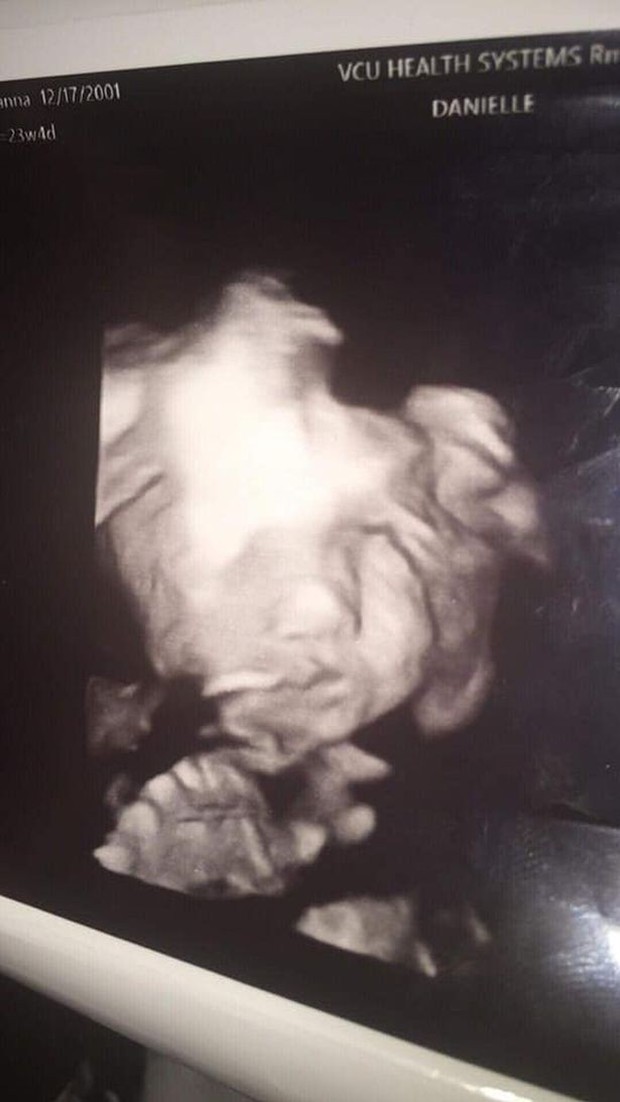 Đi siêu âm thai nhi 24 tuần tuổi, bà mẹ hết hồn khi thấy hình ảnh bé con như đang nhìn chằm chằm mình - Ảnh 2.