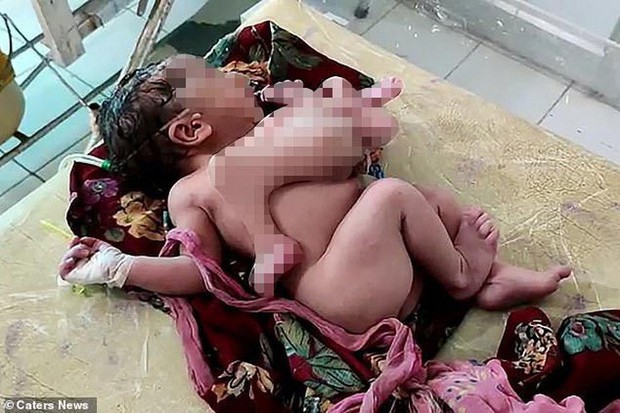  Bé gái chào đời với bốn chân và ba tay ở Ấn Độ  - Ảnh 2.