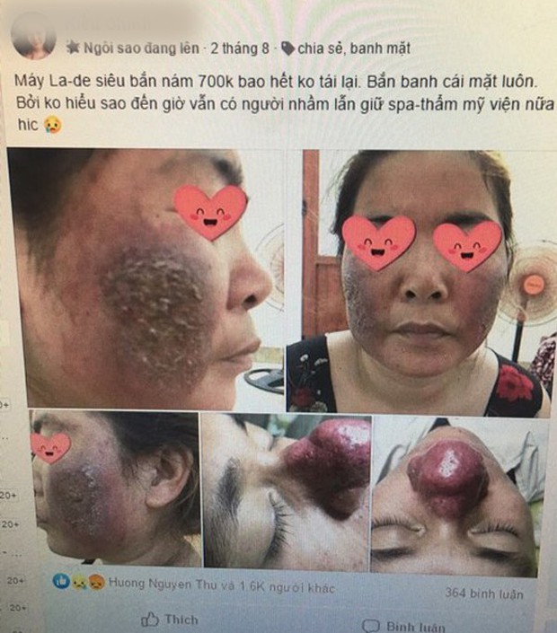 Mặt nát tanh bành chỉ vì ham hố  trị nám bằng laser tại spa: Chuyên gia đưa ra cảnh báo ai cũng phải dè chừng - Ảnh 1.