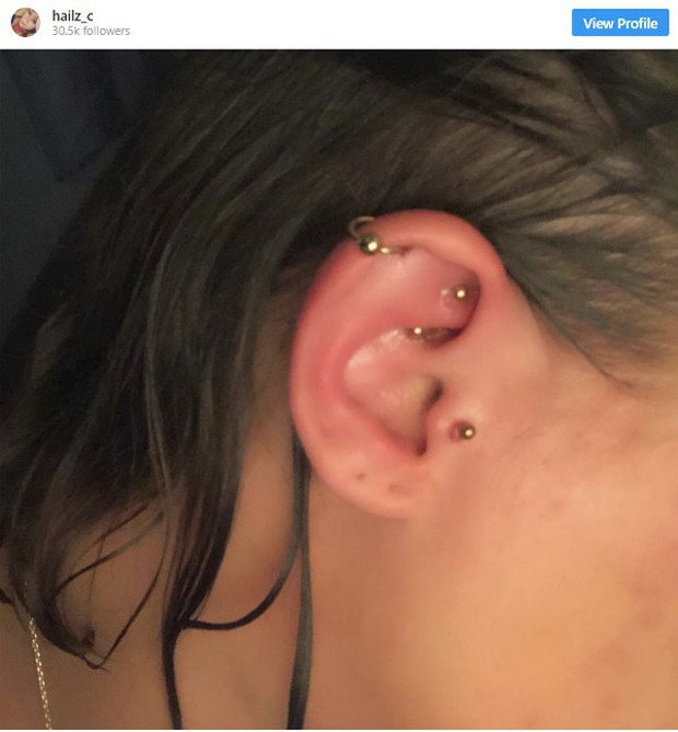 Nhiễm trùng tai trông sẽ như thế nào? 9 hình ảnh này sẽ giúp bạn hiểu chính xác tình trạng này - Ảnh 3.