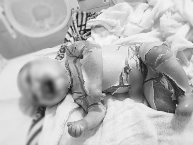 Hội chẩn trực tuyến bé sơ sinh mắc bệnh vảy cá hiếm gặp ở Hà Giang: Sẽ gửi phân tích gen tại Viện Gen để đưa ra chẩn đoán bệnh chính xác - Ảnh 1.