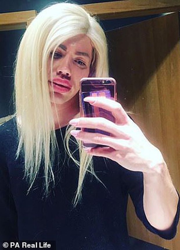 Bỏ 450 triệu đồng để sửa mặt giống búp bê Barbie, hotboy chán nản vì vẫn không tìm được bạn gái - Ảnh 5.