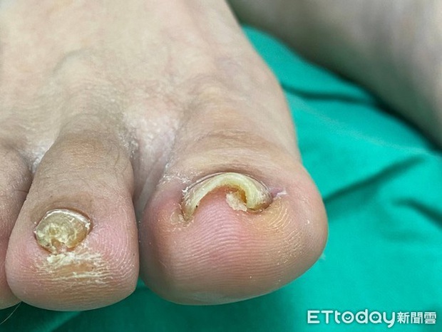 Bị đau ngón chân suốt 6 năm trời, người phụ nữ 39 tuổi đi khám mới phát hiện móng đã ăn sâu vào thịt - Ảnh 1.