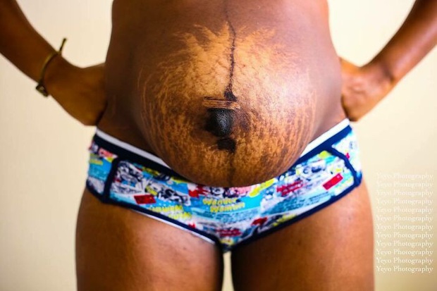 Chùm ảnh chân thật về những vết rạn sau sinh khiến ai nhìn vào cũng phải xót xa vì sự tàn phá kinh khủng đối với cơ thể phụ nữ - Ảnh 12.