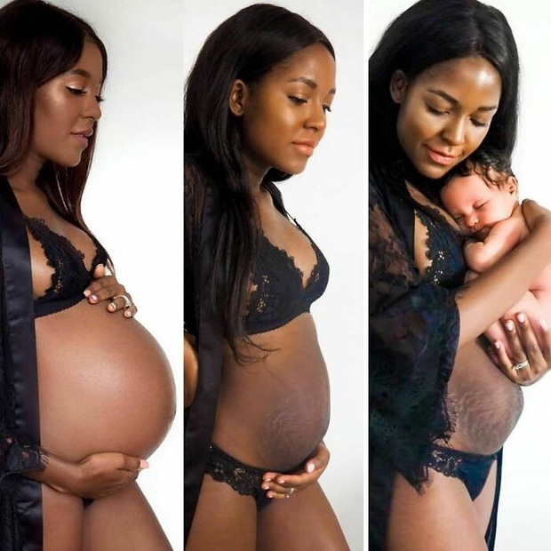 Chùm ảnh chân thật về những vết rạn sau sinh khiến ai nhìn vào cũng phải xót xa vì sự tàn phá kinh khủng đối với cơ thể phụ nữ - Ảnh 2.