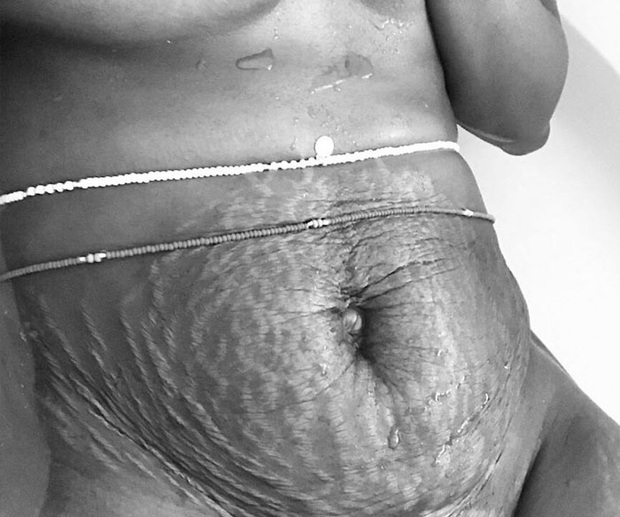 Chùm ảnh chân thật về những vết rạn sau sinh khiến ai nhìn vào cũng phải xót xa vì sự tàn phá kinh khủng đối với cơ thể phụ nữ - Ảnh 6.