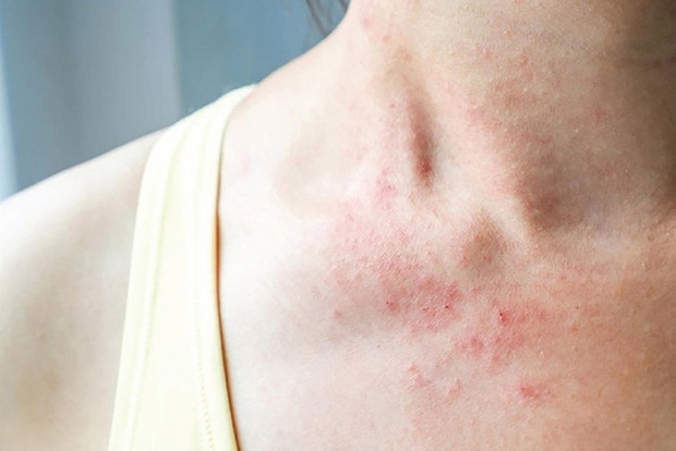 5 vấn đề bạn gặp phải trong mùa này ngầm cho thấy cơ thể đang dư thừa độ ẩm, cần tìm cách cải thiện ngay - Ảnh 1. 5 vấn đề bạn gặp phải trong mùa này ngầm cho thấy cơ thể đang dư thừa độ ẩm, cần tìm cách cải thiện ngay - Ảnh 1.
