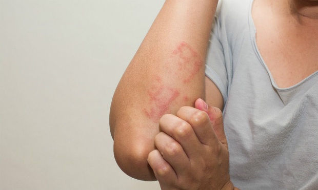 Điều gì gây ra phát ban, nổi mề đay? Hãy tìm hiểu 4 nguyên nhân chính để có thể khắc phục dứt điểm - Ảnh 1. Điều gì gây ra phát ban, nổi mề đay? Hãy tìm hiểu 4 nguyên nhân chính để có thể khắc phục dứt điểm - Ảnh 1.