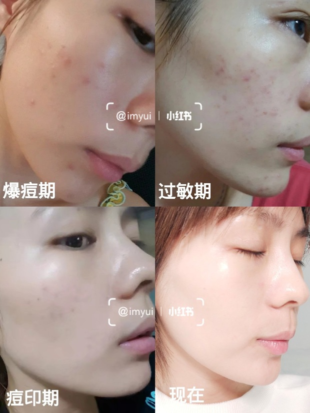 Da thiên dầu và nhiều thâm mụn, cô nàng này đánh cược với 4 sản phẩm thuộc loại xịn sò và rút ra vài kinh nghiệm vàng - Ảnh 3. Da thiên dầu và nhiều thâm mụn, cô nàng này đánh cược với 4 sản phẩm thuộc loại xịn sò và rút ra vài kinh nghiệm vàng - Ảnh 3.