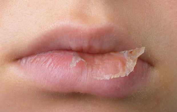 Nữ giới mắc bệnh phụ khoa thường dễ gặp phải 4 triệu chứng xấu trên đôi môi, check xem bạn có gặp phải triệu chứng nào không - Ảnh 2.
