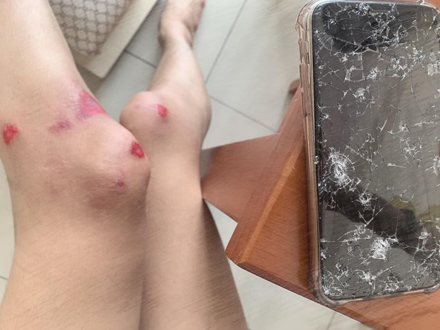 Xui như Mid Nguyễn (The Face): Cuối năm ngoái bị tài xế công nghệ hành hung, sang năm mới bị té xe, điện thoại vỡ nát - Ảnh 2.