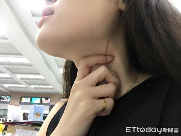 Người phụ nữ dễ bị sặc khi ăn uống, khàn tiếng kéo dài 3 tháng, đi khám mới biết mình mắc bệnh ung thư - Ảnh 2. Người phụ nữ dễ bị sặc khi ăn uống, khàn tiếng kéo dài 3 tháng, đi khám mới biết mình mắc bệnh ung thư - Ảnh 2.