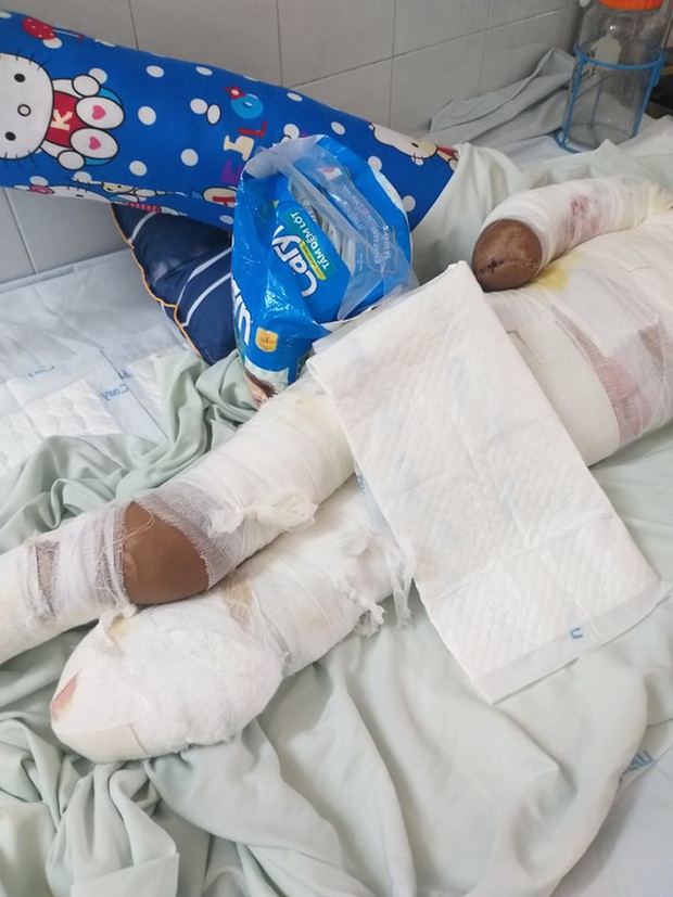 Trèo lên cột điện bắt chim, bé trai 12 tuổi bị điện giật phải cắt bỏ tay chân, tương lai mịt mù - Ảnh 2. Trèo lên cột điện bắt chim, bé trai 12 tuổi bị điện giật phải cắt bỏ tay chân, tương lai mịt mù - Ảnh 2.