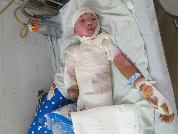 Trèo lên cột điện bắt chim, bé trai 12 tuổi bị điện giật phải cắt bỏ tay chân, tương lai mịt mù - Ảnh 4. Trèo lên cột điện bắt chim, bé trai 12 tuổi bị điện giật phải cắt bỏ tay chân, tương lai mịt mù - Ảnh 4.