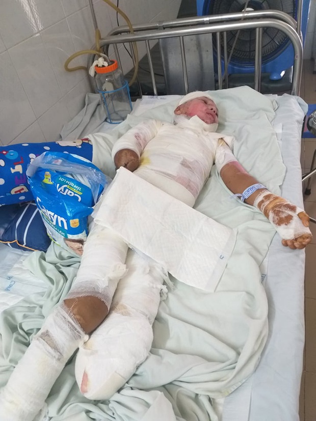 Trèo lên cột điện bắt chim, bé trai 12 tuổi bị điện giật phải cắt bỏ tay chân, tương lai mịt mù - Ảnh 6. Trèo lên cột điện bắt chim, bé trai 12 tuổi bị điện giật phải cắt bỏ tay chân, tương lai mịt mù - Ảnh 6.
