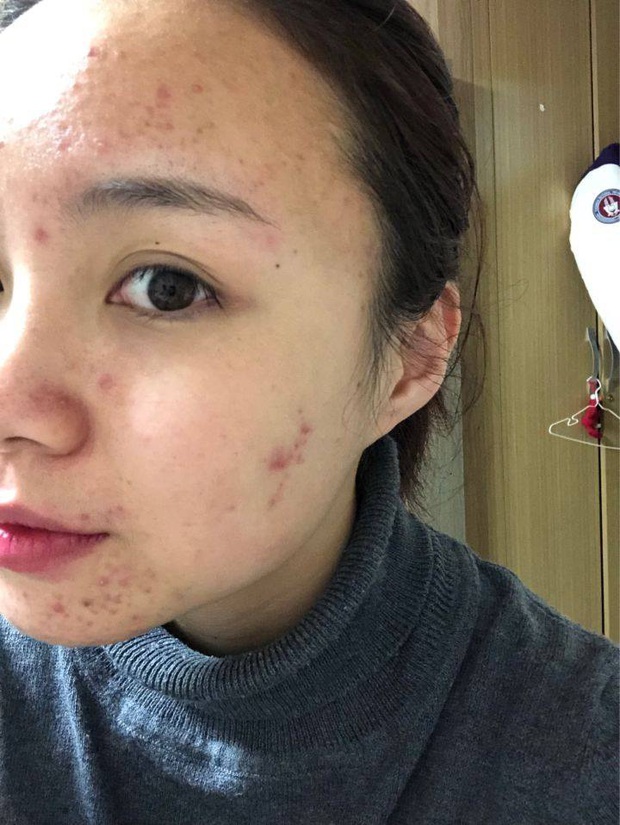 Dũng cảm công khai mặt mộc đầy mụn, cô gái chua chát: Ngũ quan đẹp mà da xấu thì cũng... vứt đi! - Ảnh 1. Dũng cảm công khai mặt mộc đầy mụn, cô gái chua chát: Ngũ quan đẹp mà da xấu thì cũng... vứt đi! - Ảnh 1.