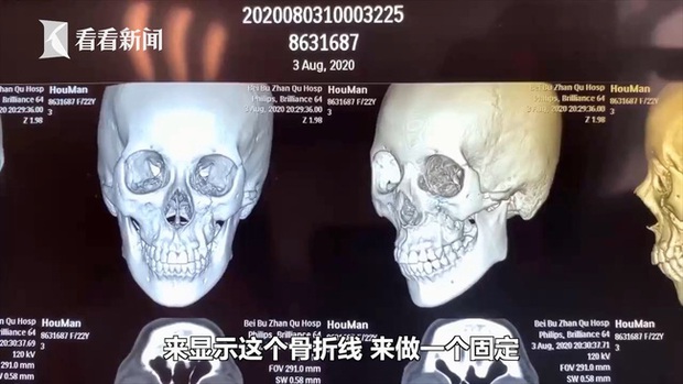 Đi công viên nước chơi, cô gái trẻ bị sóng nhân tạo đánh gãy xương mặt, khuôn mặt biến dạng phải phẫu thuật - Ảnh 6.