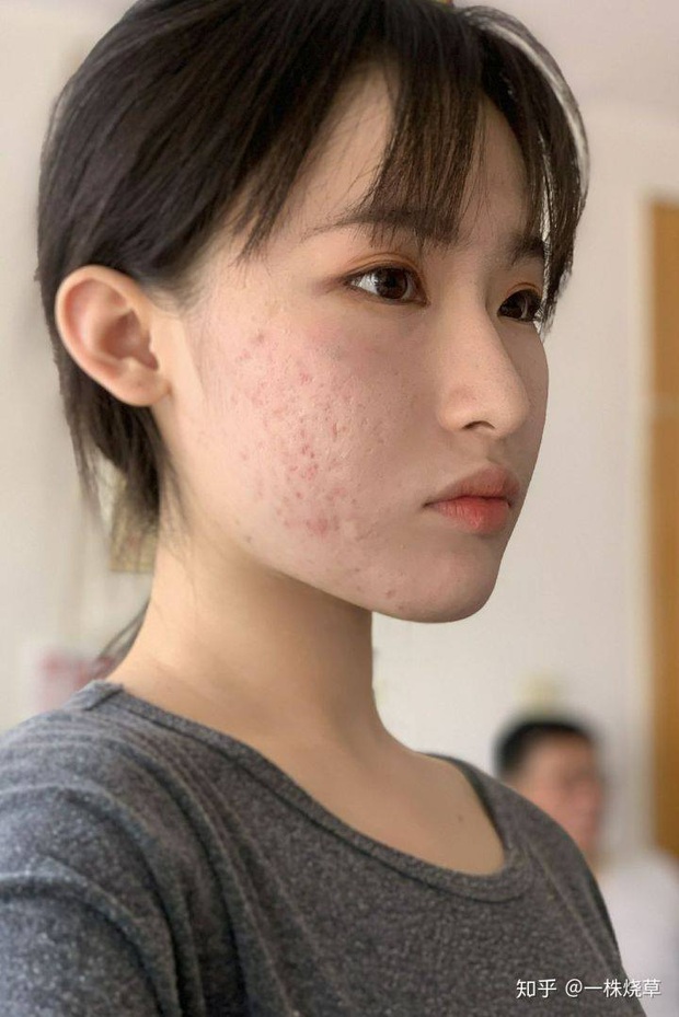 Gái xinh công khai chuyện photoshop da để sống ảo, nói hộ nỗi lòng của team bị mụn hành hạ - Ảnh 3.