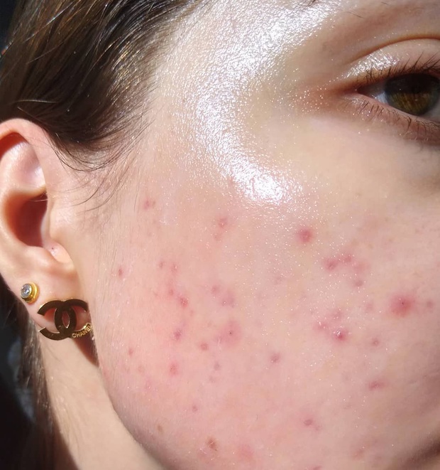 Bác sĩ da liễu chỉ đích danh lỗi sai tày trời khiến lỗ chân lông toang hoác mà chị em mắc phải khi mùa Thu đến - Ảnh 1.