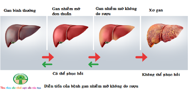 Nguyên Trưởng khoa Tiêu hóa BV Bạch Mai báo động: Có trẻ chưa lớp 1 gan đã trắng xóa mỡ - Ảnh 3. Nguyên Trưởng khoa Tiêu hóa BV Bạch Mai báo động: Có trẻ chưa lớp 1 gan đã trắng xóa mỡ - Ảnh 3.
