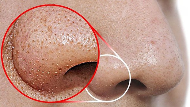 Beauty blogger người Nhật dạy cách trị mụn đầu đen ngay từ bước rửa mặt, nhấn mạnh lột mụn làm da lão hóa cực nhanh - Ảnh 1. Beauty blogger người Nhật dạy cách trị mụn đầu đen ngay từ bước rửa mặt, nhấn mạnh lột mụn làm da lão hóa cực nhanh - Ảnh 1.