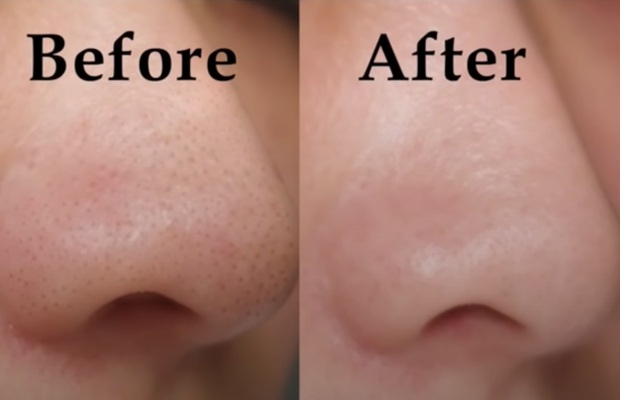 Beauty blogger người Nhật dạy cách trị mụn đầu đen ngay từ bước rửa mặt, nhấn mạnh lột mụn làm da lão hóa cực nhanh - Ảnh 4. Beauty blogger người Nhật dạy cách trị mụn đầu đen ngay từ bước rửa mặt, nhấn mạnh lột mụn làm da lão hóa cực nhanh - Ảnh 4.