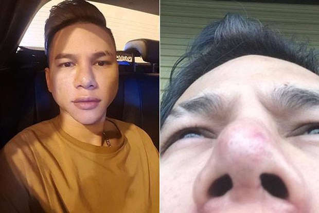 6 sao Việt khổ sở vì dao kéo biến dạng: Angela Phương Trinh lệch hẳn 1 bên mũi, Hồ Quỳnh Hương - Phi Thanh Vân gây choáng - Ảnh 23. 6 sao Việt khổ sở vì dao kéo biến dạng: Angela Phương Trinh lệch hẳn 1 bên mũi, Hồ Quỳnh Hương - Phi Thanh Vân gây choáng - Ảnh 23.