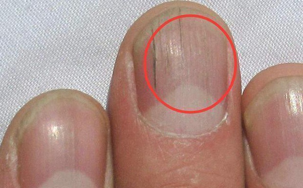 Quan sát đôi tay, nếu thấy có 3 tín hiệu xấu thì nên chú ý sức khỏe vì nguy cơ mắc bệnh về gan rất cao - Ảnh 2. Quan sát đôi tay, nếu thấy có 3 tín hiệu xấu thì nên chú ý sức khỏe vì nguy cơ mắc bệnh về gan rất cao - Ảnh 2.
