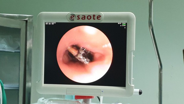 Gỡ hạt hồng xiêm nằm vắt ngang trong phế quản cô gái suốt 27 năm - Ảnh 1.