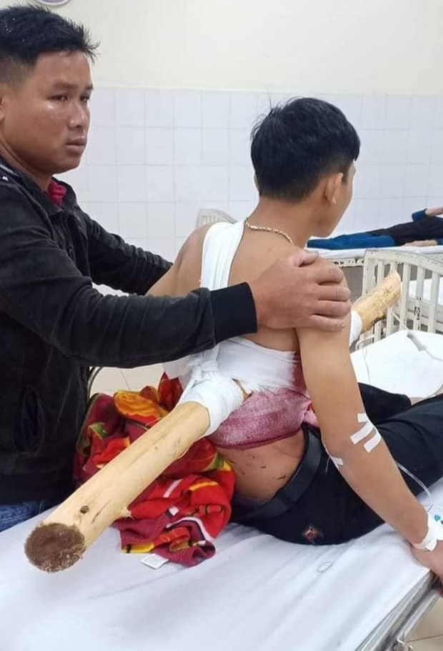 Kinh hoàng nam sinh 16 tuổi chạy xe máy bị cây keo đâm xuyên người - Ảnh 2.