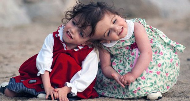 Cặp sinh đôi dính liền đầu có thể đọc được suy nghĩ của nhau, từng khiến thế giới ngỡ ngàng 14 năm trước giờ ra sao? - Ảnh 2.