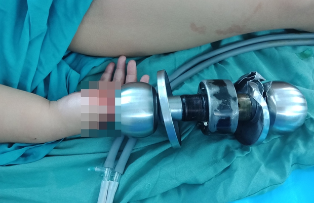 Bé trai 3 tuổi bị kẹt tay vào ổ khóa phải nhập viện, bác sĩ nhi đồng liền đưa lời khuyên cho các bậc phụ huynh - Ảnh 1. Bé trai 3 tuổi bị kẹt tay vào ổ khóa phải nhập viện, bác sĩ nhi đồng liền đưa lời khuyên cho các bậc phụ huynh - Ảnh 1.