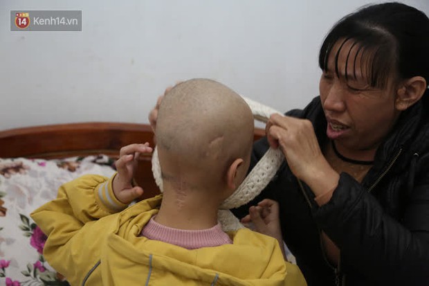Cô bé 12 tuổi phẫu thuật não để điều trị ung thư: Trước đây con xinh lắm, giờ xạ trị nhiều nên chẳng còn tóc nữa - Ảnh 5. Cô bé 12 tuổi phẫu thuật não để điều trị ung thư: Trước đây con xinh lắm, giờ xạ trị nhiều nên chẳng còn tóc nữa - Ảnh 5.