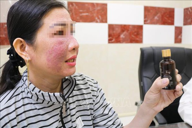 Nhiều chị em bị tai biến do làm trắng da cấp tốc đón Tết - Ảnh 1.