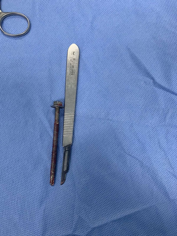 Người đàn ông đến bệnh viện với chiếc ốc vít dài 6cm xoáy vào giữa dương vật - Ảnh 1. Người đàn ông đến bệnh viện với chiếc ốc vít dài 6cm xoáy vào giữa dương vật - Ảnh 1.