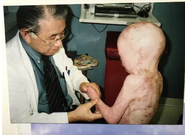 Cậu bé từng bị bỏng 95% cơ thể, trải qua 87 cuộc phẫu thuật đau đớn, bị gọi là người ngoài hành tinh bây giờ ra sao sau nhiều năm? - Ảnh 3.