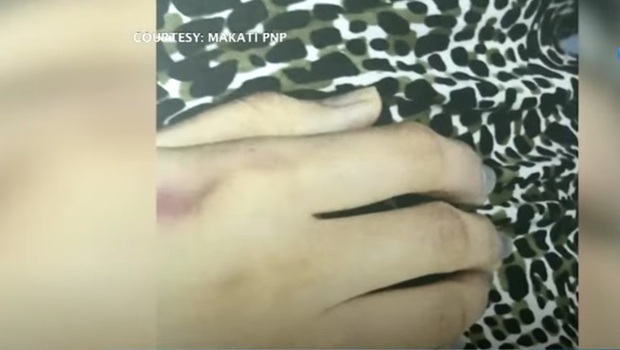 Công bố hình ảnh bầm tím khắp người của Á hậu Philippines, 3 nghi phạm được thả tự do bật khóc nức nở - Ảnh 1.