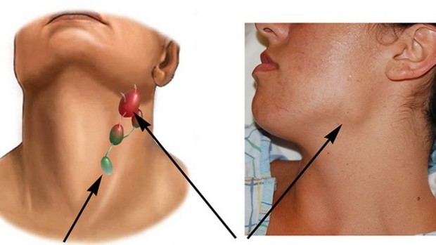 Hạch sưng to trên cổ nếu đi kèm với 4 hiện tượng bất thường thì nên đi khám càng sớm càng tốt - Ảnh 1. Hạch sưng to trên cổ nếu đi kèm với 4 hiện tượng bất thường thì nên đi khám càng sớm càng tốt - Ảnh 1.