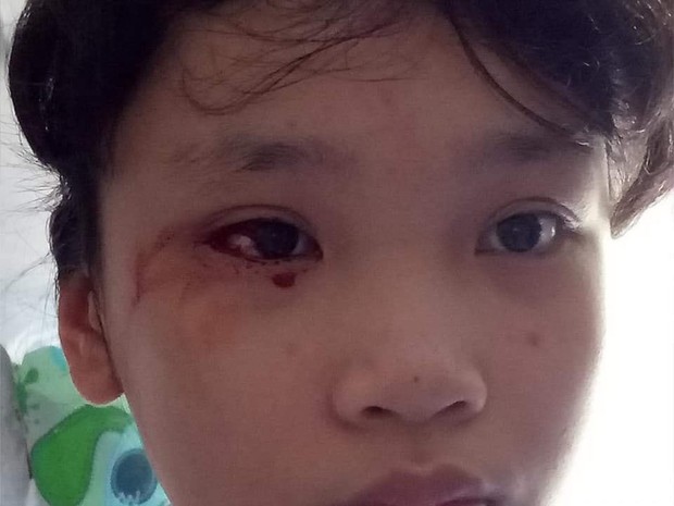 Nữ sinh 12 tuổi vỡ mạch máu mắt vì nhìn màn hình điện thoại 8 tiếng mỗi ngày trong thời gian dài - Ảnh 2. Nữ sinh 12 tuổi vỡ mạch máu mắt vì nhìn màn hình điện thoại 8 tiếng mỗi ngày trong thời gian dài - Ảnh 2.