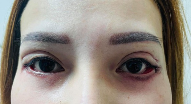 Hậu quả khôn lường từ việc cắt mí mắt tại cơ sở chui giá KHÔNG RẺ: Mắt phải treo ngược cành cây, đi ngủ giờ cũng là thử thách - Ảnh 2. Hậu quả khôn lường từ việc cắt mí mắt tại cơ sở chui giá KHÔNG RẺ: Mắt phải treo ngược cành cây, đi ngủ giờ cũng là thử thách - Ảnh 2.